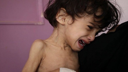 サウジのイエメン攻撃により、イエメン人の子どもが栄養不良