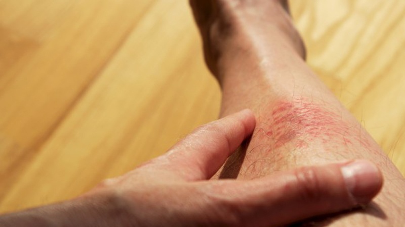 10 remèdes naturels pour soulager l’eczéma
