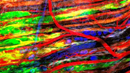 Tumori, le metastasi si muovono come una 'folla'