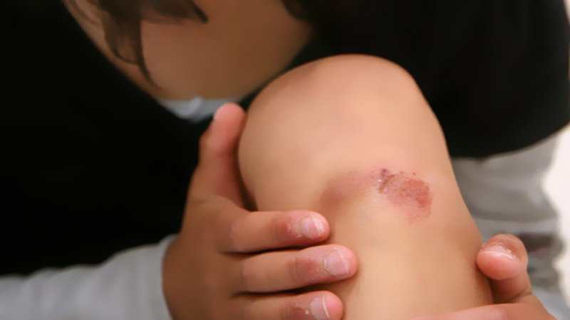 8 remèdes naturels pour les petits bobos au quotidien