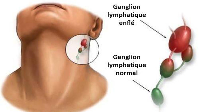 7 points pour mieux connaître la tuberculose