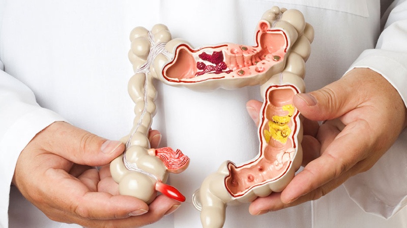 9 façons de gérer le syndrome de côlon irritable