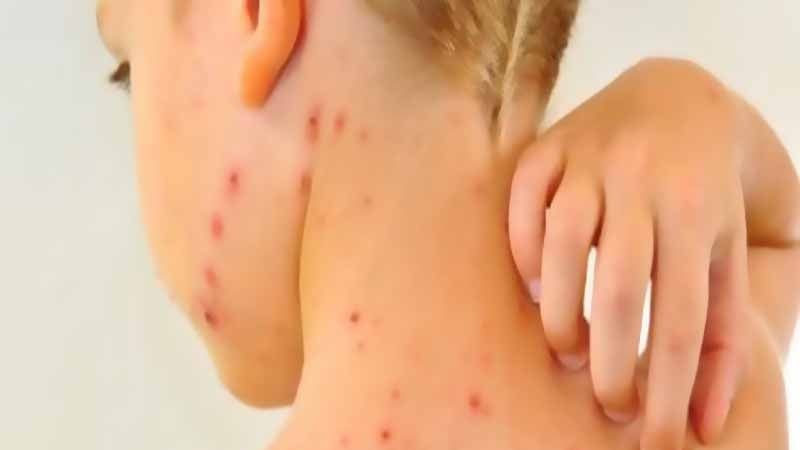10 remèdes 100% naturels contre les démangeaisons de la peau