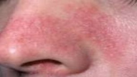 Мушкилоти пустиро бо ин витамин дармон кунед