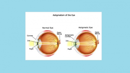 Ашхоси дучори астигматизм шуда ба витаминҳо ниёз доранд 