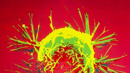 Tumore del seno, scoperte le varianti genetiche 'pop'