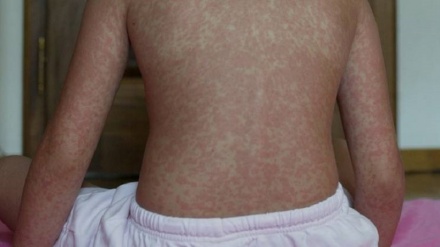 Il morbillo dilaga