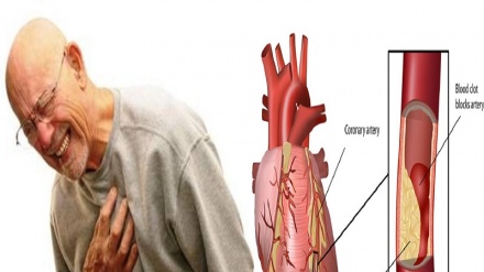 ضربان / دردهای قفسه صدری یا سینه -1