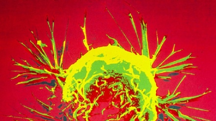 Scoperto un 'freno' nei tumori che blocca le metastasi