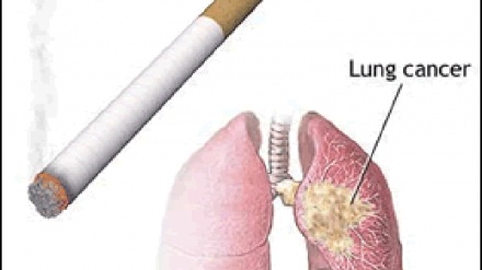 SAUTI, Kampeni ya kupambana na magonjwa ya Sarati mbalimbali imeshika kasi nchini Uganda ambapo watu wanapimwa bure