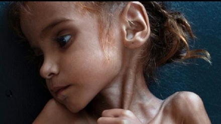 সৌদি আগ্রাসন: দুর্ভিক্ষে মারাই গেল ইয়েমেনি শিশুটি