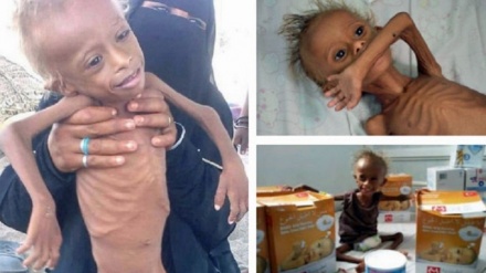 UNICEF: Watoto milioni nane Yemen wanakabiliwa na hali mbaya ya lishe duni
