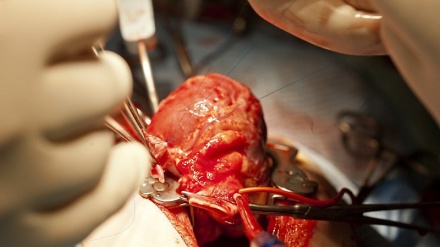 Primo pacemaker ricaricato dal cuore