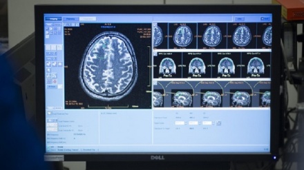 Alzheimer: scoperta interazione tra virus e proteine