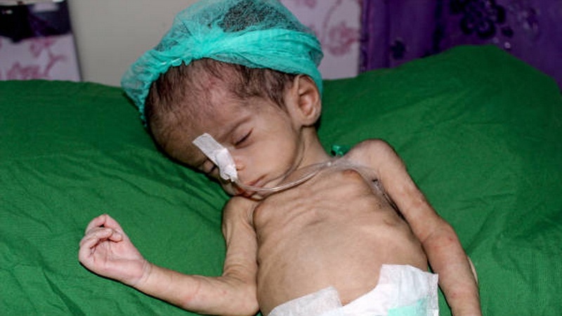 وزارت بهداشت یمن: هر 10 دقیقه یک کودک یمنی می میرد 