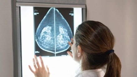 Tumore seno, nuovo test scopre le recidive in fase iniziale