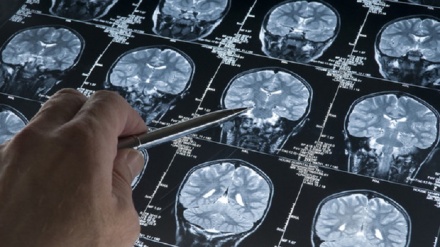 Scoperta alternativa cure per ricadute dei tumori cerebrali