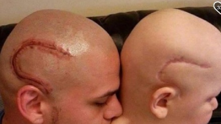 Nuovo percorso cura su un grave tumore infantile al cervello