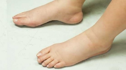 نکاتی برای کاهش سریع‌تر تورم پا