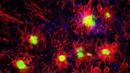 Alzheimer, scoperta molecola che blocca la malattia