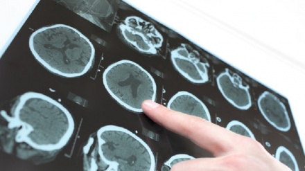 Parkinson, ultrasuoni 'sparati' sul cervello fermano tremori