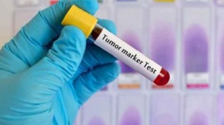 Creato un test del sangue che scova 50 diversi tumori