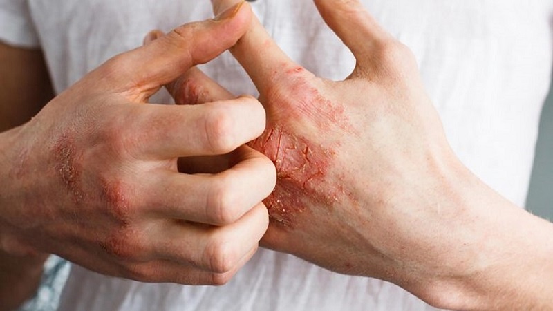 اگزما، بیماری پوستی روز‌های کرونایی