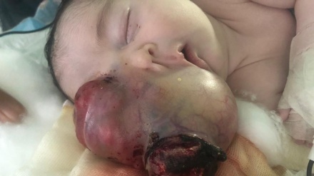 イランで、乳児の顔の皮下腫瘍摘出手術に成功