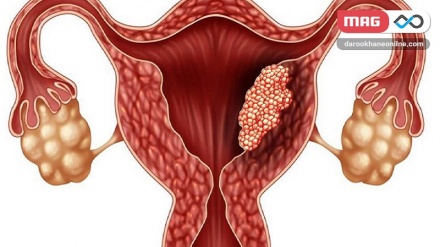 سرطان دهانه رحم (2)