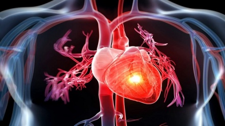 ضربان / پرولاپس یا افتادگی دریچه میترال قلب -1