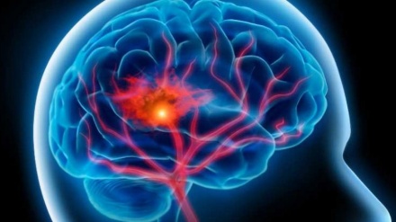  علائم ظاهری سکته مغزی چیست؟ 