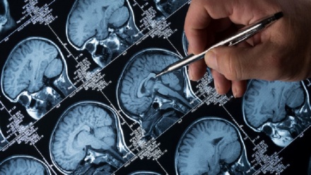 Gli effetti del Covid sul cervello, 300 studi mettono in allarme