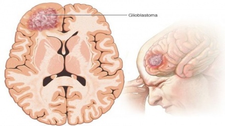 ضربان / تومورها ی مغزی -2