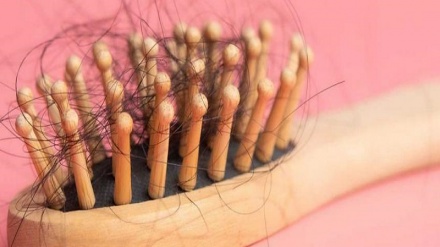 راهکارهای درمان ریزش مو بعد از کرونا
