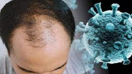  آیا ریزش مو از عوارض طبیعی کروناست؟