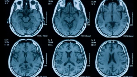 Study shows COVID-19 infection linked to brain shrinkage, cognitive decline