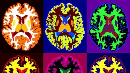 Sviluppo e malattie, ora un 'metro' misura il cervello 