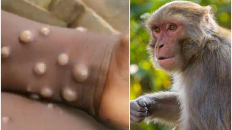 شیوع ویروس آبله میمون در چند کشور جهان 