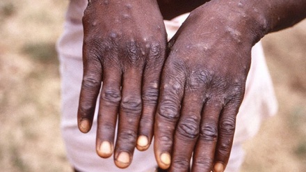 ‘Now Britons have to deal with it’: What’s going on in the UK with monkeypox?