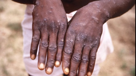 WHO、「サル痘が12カ国で92人確認、今後も増加へ」