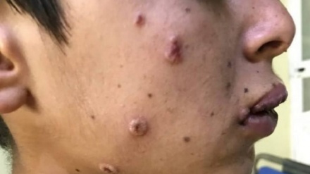 منابع صحی: اولین واقعه مشکوک به بیماری آبله میمون در هرات ثبت شد