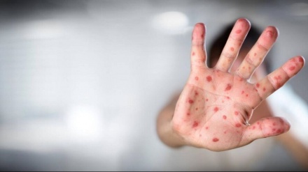 米CDCが、サル痘の感染拡大に関して警告