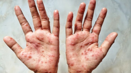 מקרה שני של אבעבועות קוף התגלה בישראל