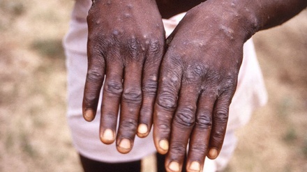 Monkeypox in Africa: The science the world ignored