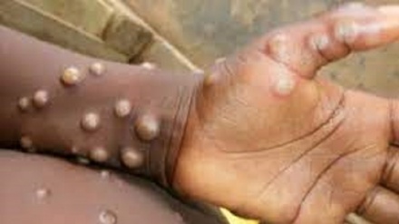 Vaiolo scimmie,oltre 200 casi in Europa