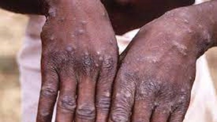 Vaiolo scimmie, in Canada aprono prime cliniche per vaccino