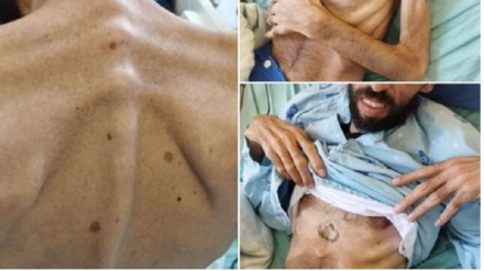 Ini Respon Uni Eropa setelah Menyaksikan Kondisi Fisik Khalil Awawdeh