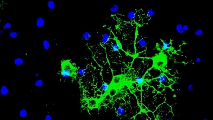 Sclerosi multipla, nuova via per ridurre i danni neurologici