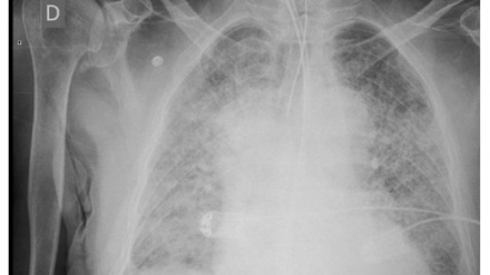 Una misteriosa malattia respiratoria in Argentina