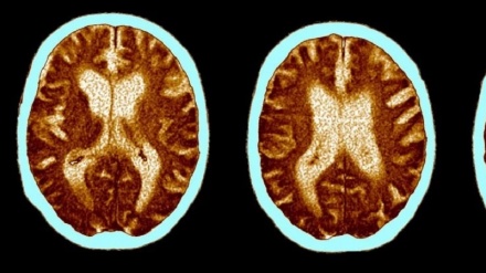 Covid: sono state riscontrate modifiche del cervello in seguito all’infezione 